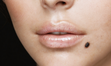 découvrez ce que les grains de beauté révèlent sur votre santé et votre peau, et apprenez à les surveiller pour mieux comprendre votre corps.